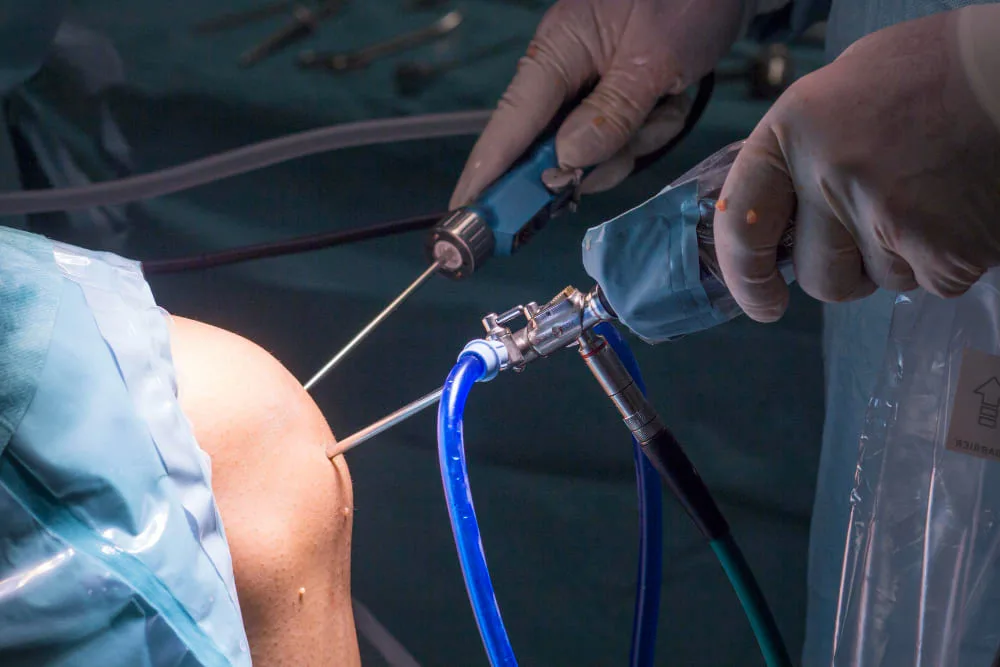 Artroscopia de rodilla, hombro y tobillo en Zapopan, Jalisco: Cirugía mínimamente invasiva para articulaciones