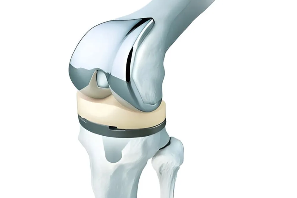 Prótesis de rodilla, cadera y hombro en Zapopan, Jalisco: Reemplazo articular para recuperar movilidad